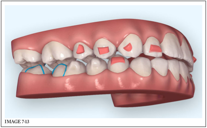 Transverse | Pocket Dentistry