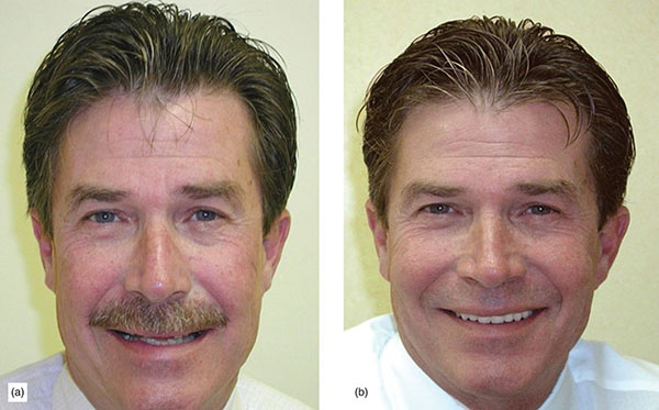 Photographs show patient’s photo before undergoing veneer and after undergoing veneer, where teeth structure is completely different and healthy.