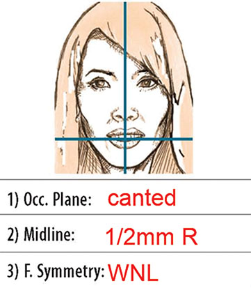 Diagram shows closed-up view of notes which is observed and recorded on diagnosis form which reads 1) Occ. Plane: canted; 2) Midline: 1/2mm R; and 3) F.Symmetry: WNL.