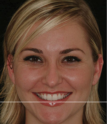 Photograph shows lady’s full face smiling which is occlusal plane, where line is drawn parallel to horizon and that touches incisal edge of both centrals.