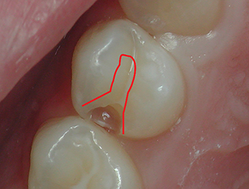 Photograph shows tooth-conserving composite preparation does not require bulk for strength when compared with traditional occlusal outline for amalgam preparation.