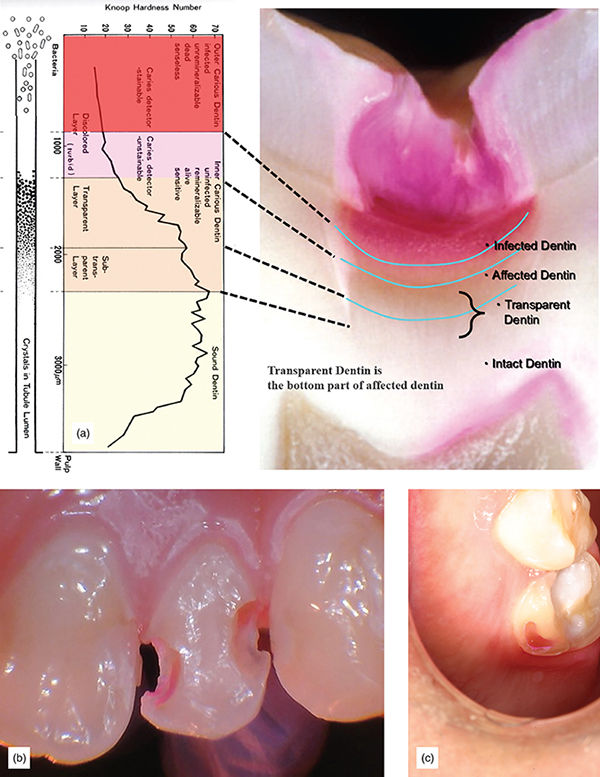 Photographs show a: caries layer with infected dentin, affected dentin, and transparent dentin; b: dentin which is stained red is affected and should be removed; and c: caries indicator used to uncover caries on tooth.