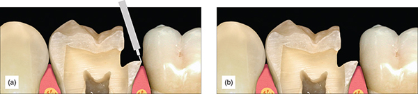 Photographs show completed preparation with some minor beveling, where material like amalgam needs strong packing to seal margins.