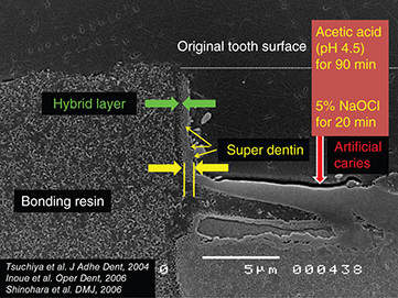 Photograph shows microscopic view of super dentin structure having hybrid layer above super dentin, bonding resin region where measurement is 5mm with acetic acid of pH 4.5.