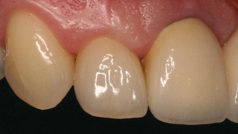 Procedures in Aesthetic Dentistry Pocket Dentistry