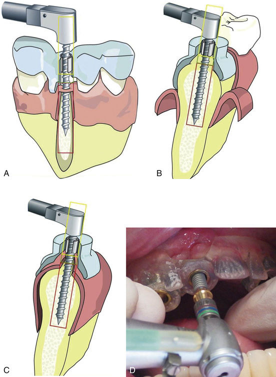 Ideal Implant Positioning Pocket Dentistry