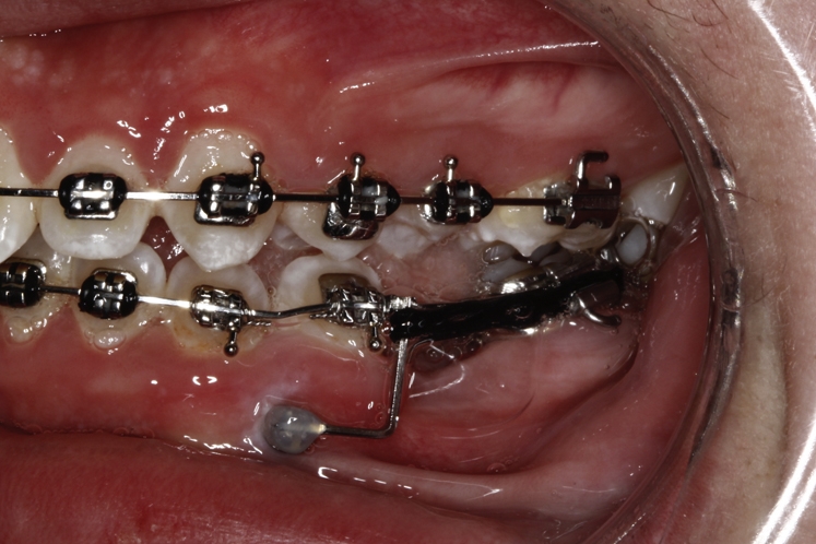 Ten years of miniscrew use in a U.S. orthodontic residency program ...