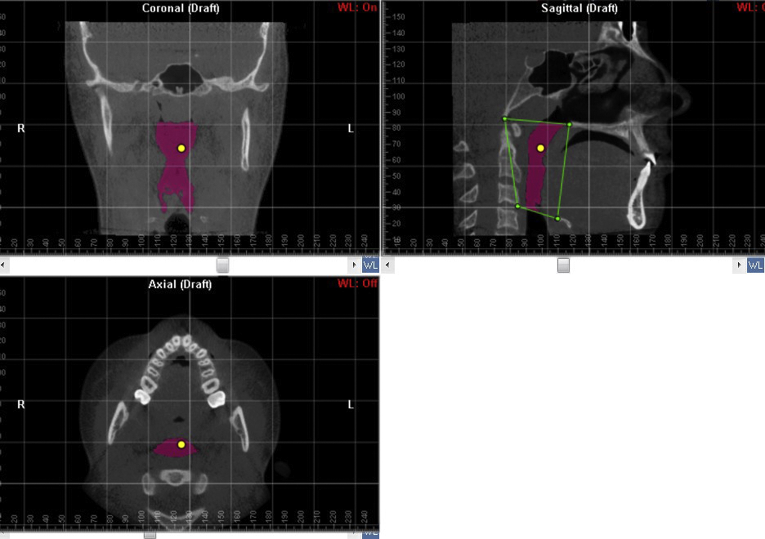 Oropharyngeal 3-dimensional changes after maxillary expansion with 2 ...