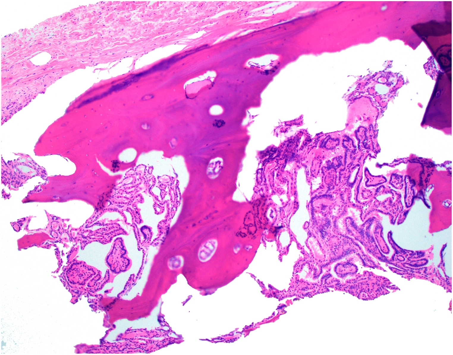 Papillary carcinoma arising in a presumed thyroglossal duct cyst with ...