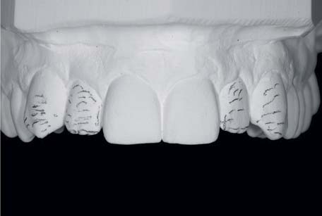 Tooth preparation: current concepts for material selection