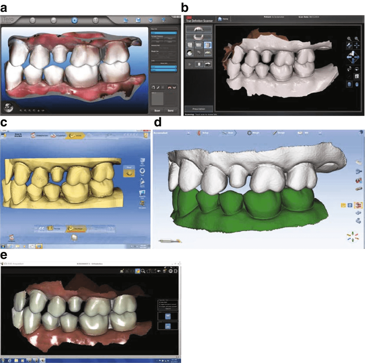 What is Digital Impression Technology and Applications in Restorative Dentistry