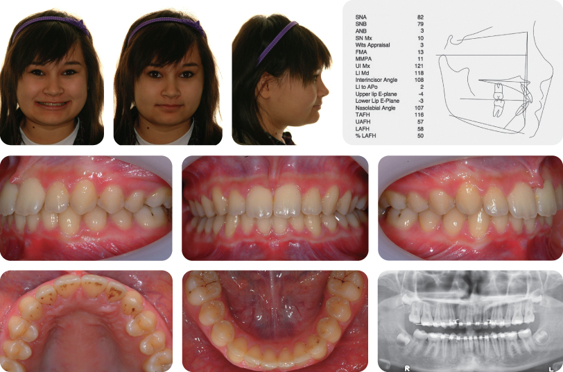 The molar relationships are class ii where the maxillary central incisors are retroclined. 4 Class II Division 1 Malocclusion | Pocket Dentistry