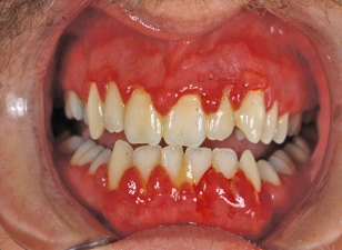9 Bleeding Disorders Pocket Dentistry 9 Bleeding Disorders Pocket Dentistry