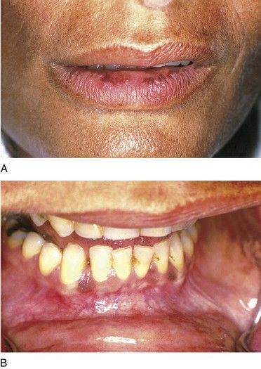People with color blindness see a totally different world, according to the coblis photo simulator. 15: Adrenal Insufficiency | Pocket Dentistry