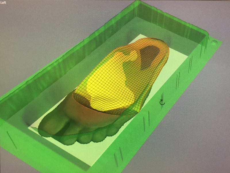 SEMELLES ORTHOPÉDIQUES (ORTHÈSES PLANTAIRES) SUR MESURE