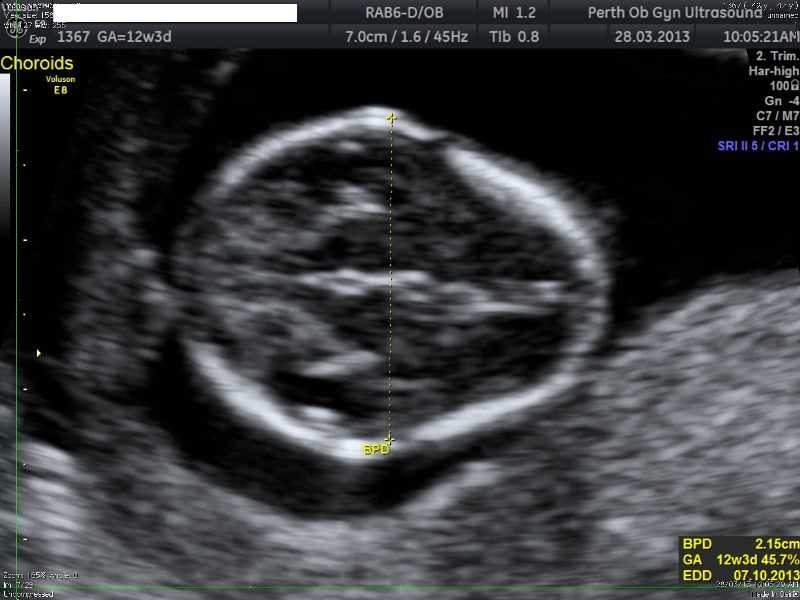 Pdf First Trimester Screening - Ultra HD Colorful Designs for Desktop