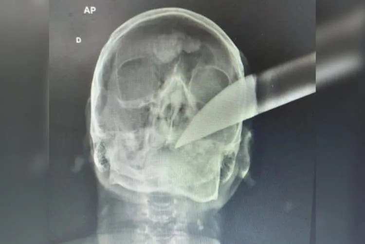 Raio-X mostra facão cravado na cabeça de homem após briga