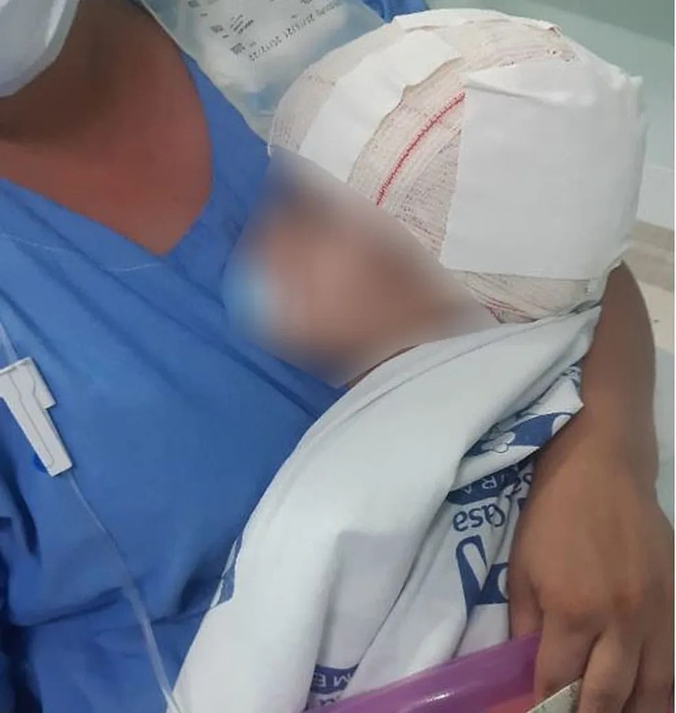 Menina de 2 anos é atacada na cabeça por pitbull