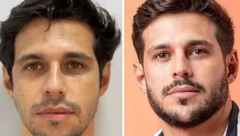 Rodrigo fez harmonização facial para entrar no BBB 22