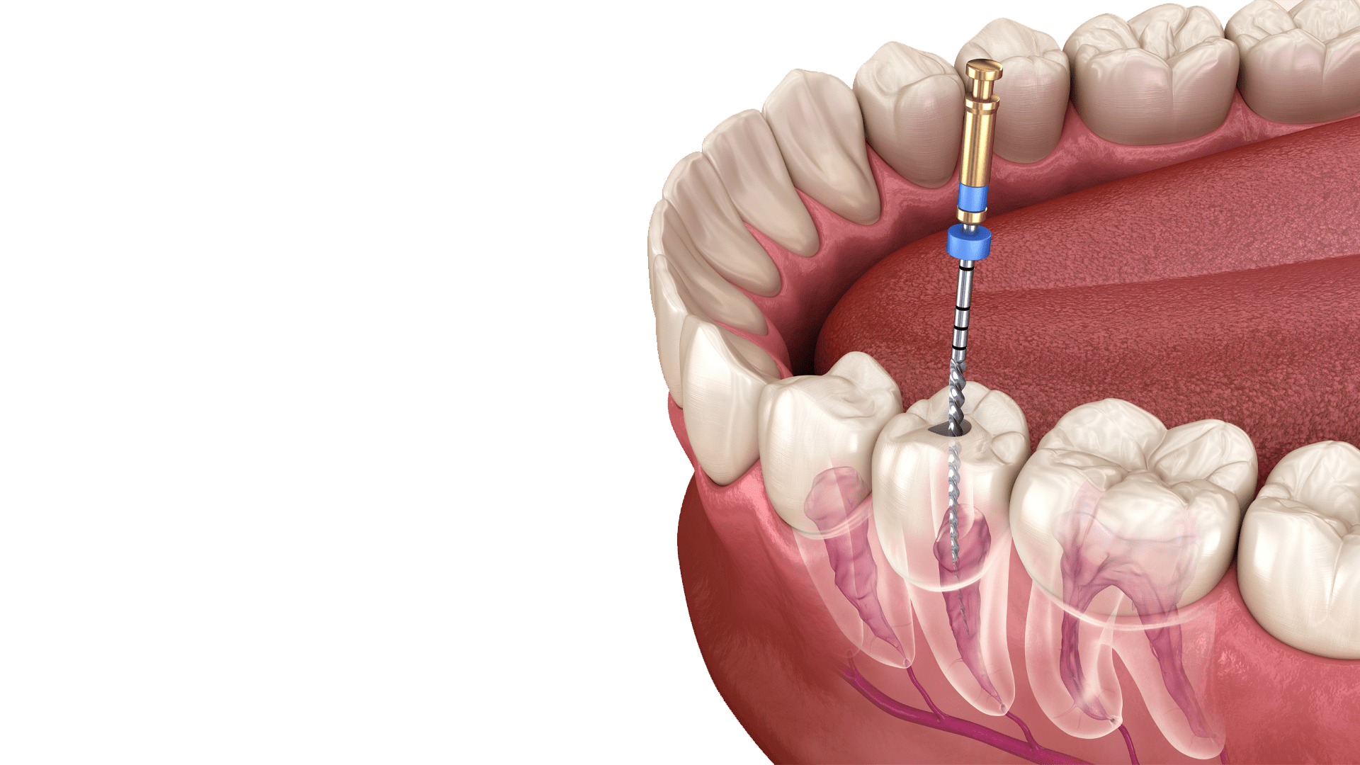 Failed root canal: causes, symptoms, and treatments