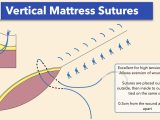 Wound Closure Techniques