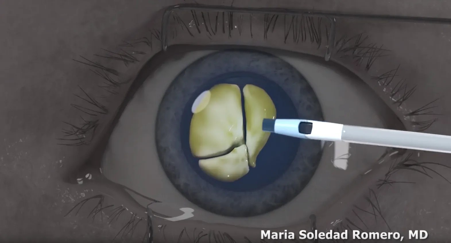 iol cataract