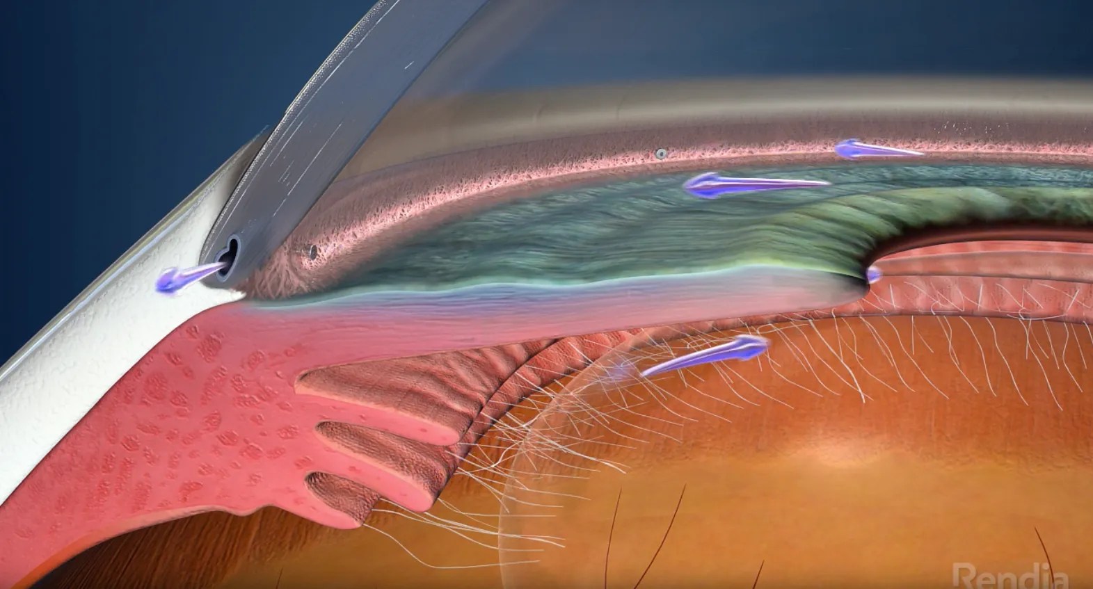 glaucoma