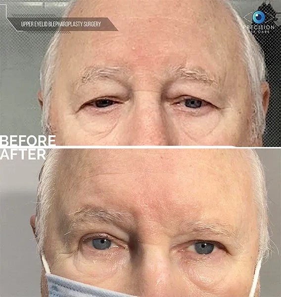 Eyelid Surgery (Blepharoplasty)