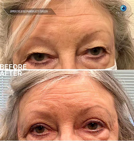 Eyelid Surgery (Blepharoplasty)
