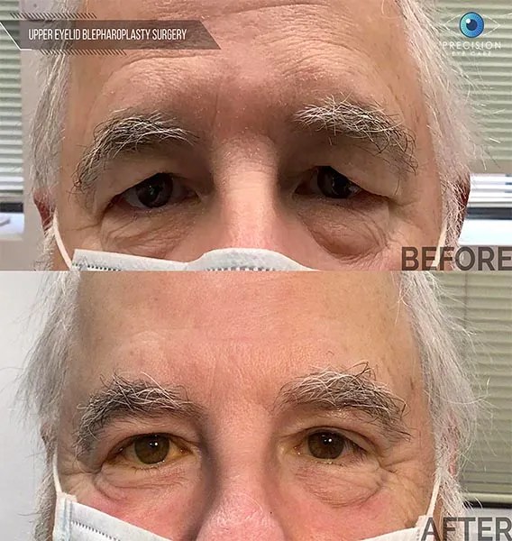 Eyelid Surgery (Blepharoplasty)