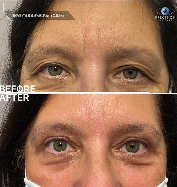 Eyelid Surgery (Blepharoplasty)