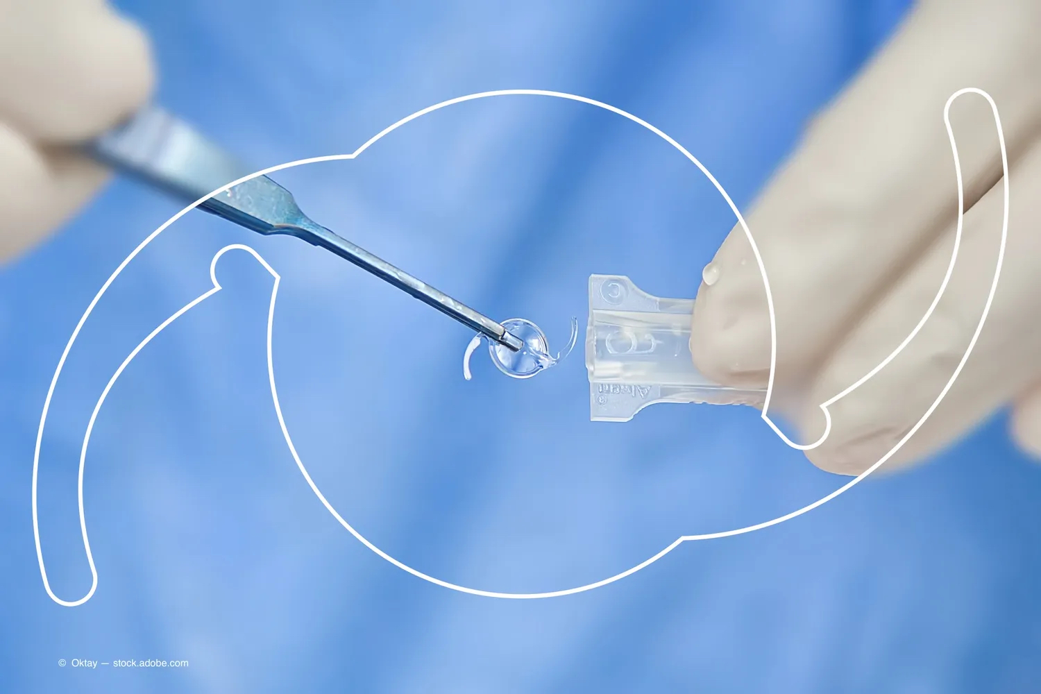 New intraocular implant to correct Presbyopia