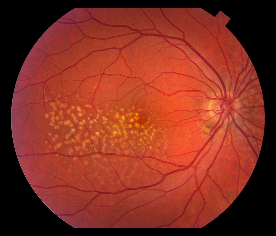macular degeneration
