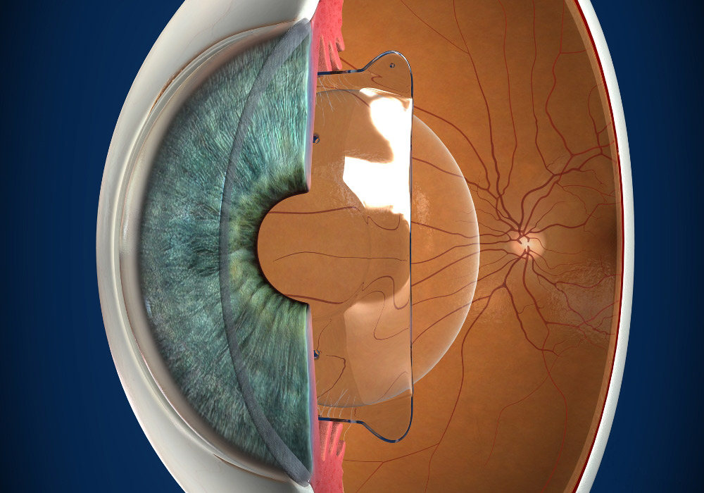 Implantable Collamer Lenses