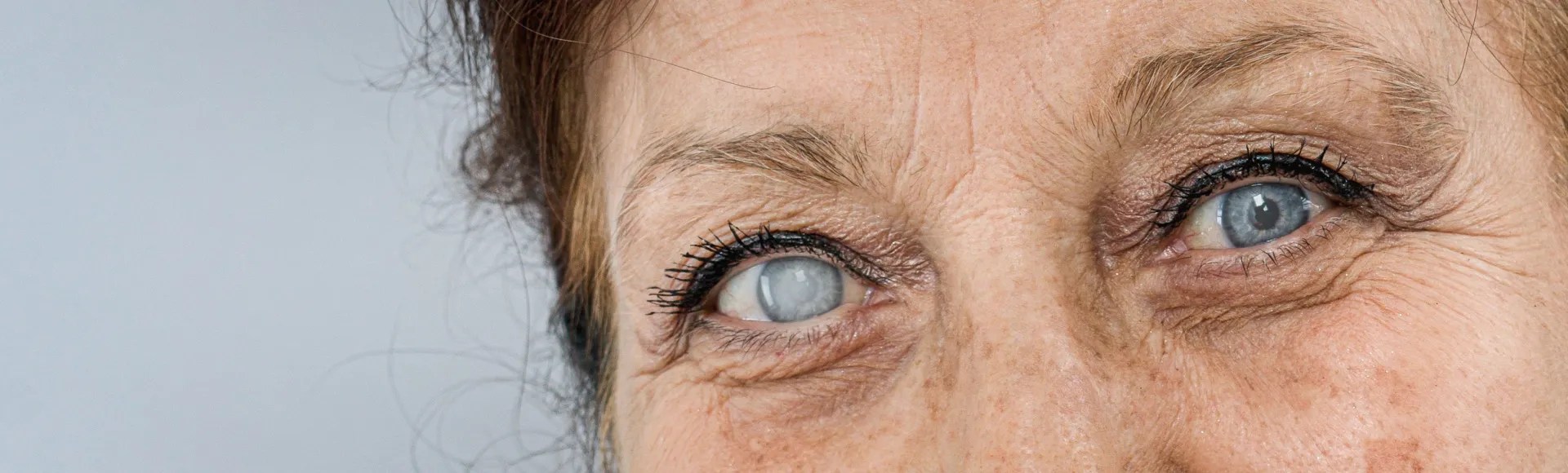Cataract Untreated