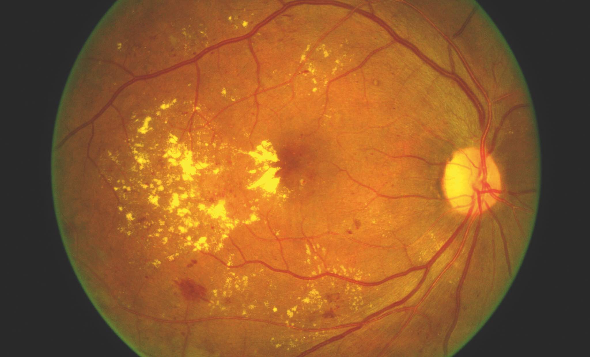 Maculopathy