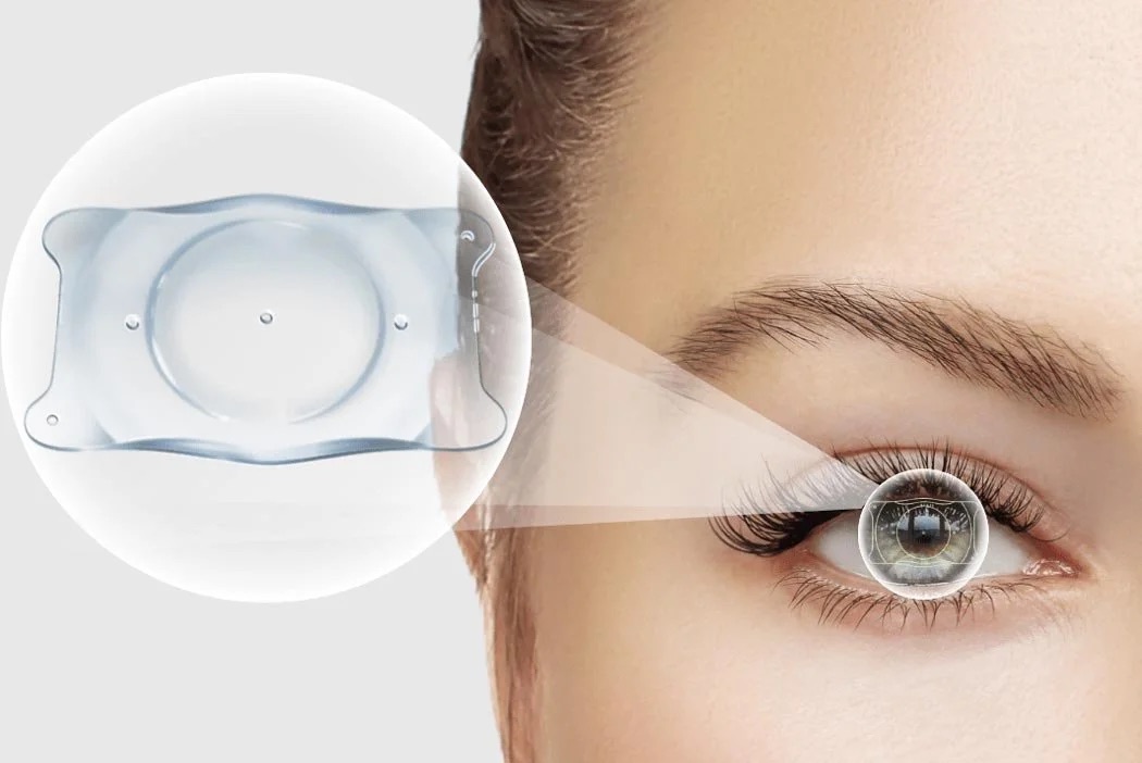 EVO ICL IMPLANT