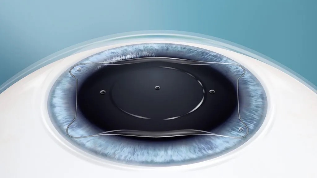 EVO ICL LENS