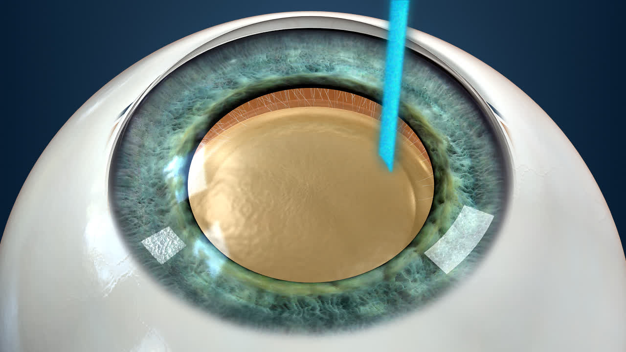 Micro-Invasive Cataract Surgery