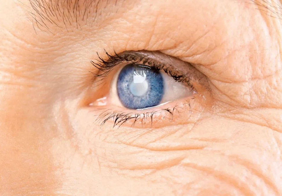 cataract surgery recovery