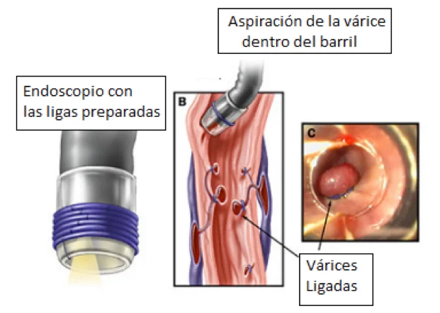 varices-esofagicas-3