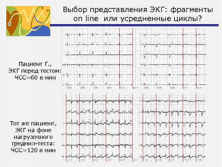 Нагрузочные тесты в диагностике ибс. Зачёт по экг. Ответы на тест экг. Ecg right branch bundle block. Экг вектор.