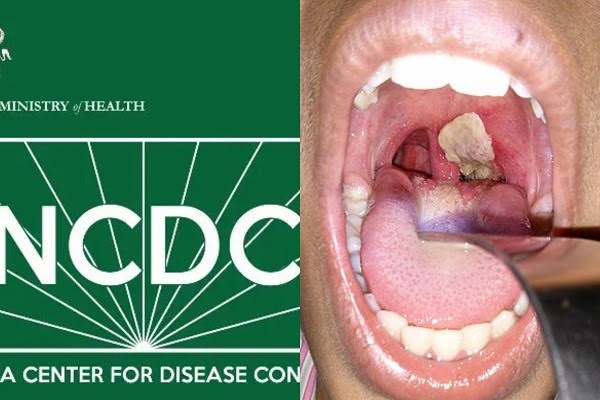 FG Warns Nigerians About Diphtheria Outbreak