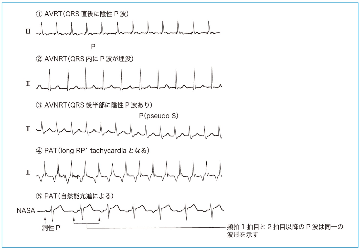 Psvt 運動 発作性上室性頻拍 Cxana