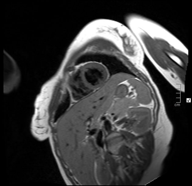 wallpapers Myocarditis Mri acute myocarditis radiology case radiopaedia org