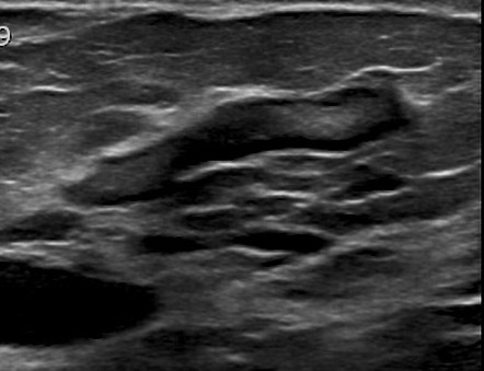 The pec major) is the one that commands the most real estate. Image | Radiopaedia.org
