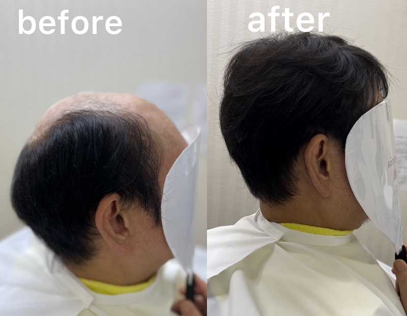 プロピアヘアコンタクト前髪 ヘアコンタクト｜ヘアコンタクト・増毛・育毛・発毛のプロピア