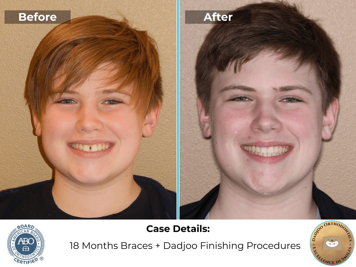Teen Braces - Before and After with Board Certified Orthodontist Dr. Dadjoo - Porter Ranch, California