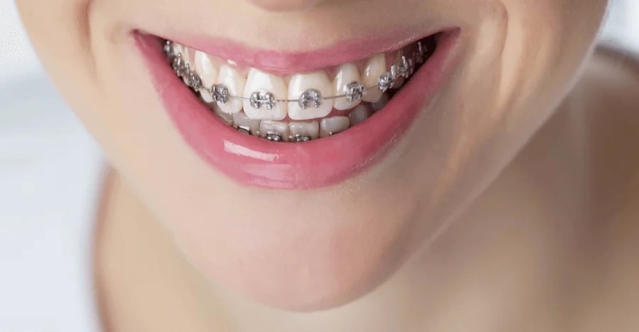新山牙套矫正治疗 — QP Dental 黄氏牙科