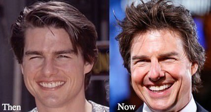 Tom cruise's teeth were realigned thanks to the braces, and his dental midline was restored. Does Tom Cruise Have Fake Teeth Quora